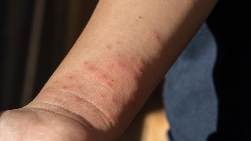 Are Bed Bug Bites Dangerous